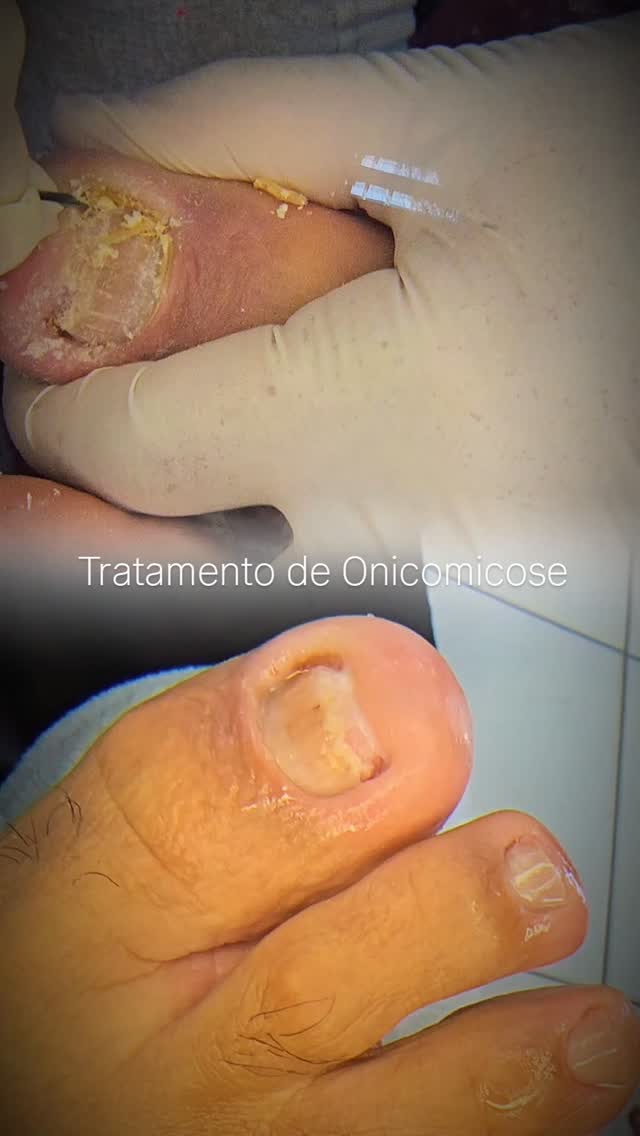 Tratamento de unhas